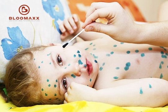 Cách chăm sóc trẻ bị thuỷ đậu tại nhà